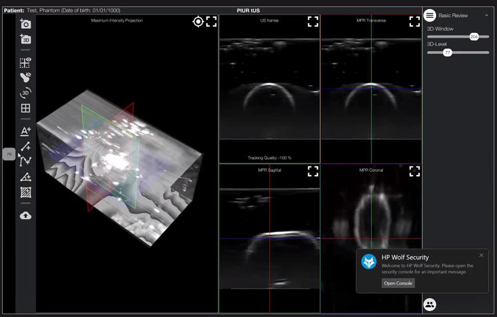 UltraClear interface showing a three-dimensional ultrasound reconstruction and tracked imaging planes